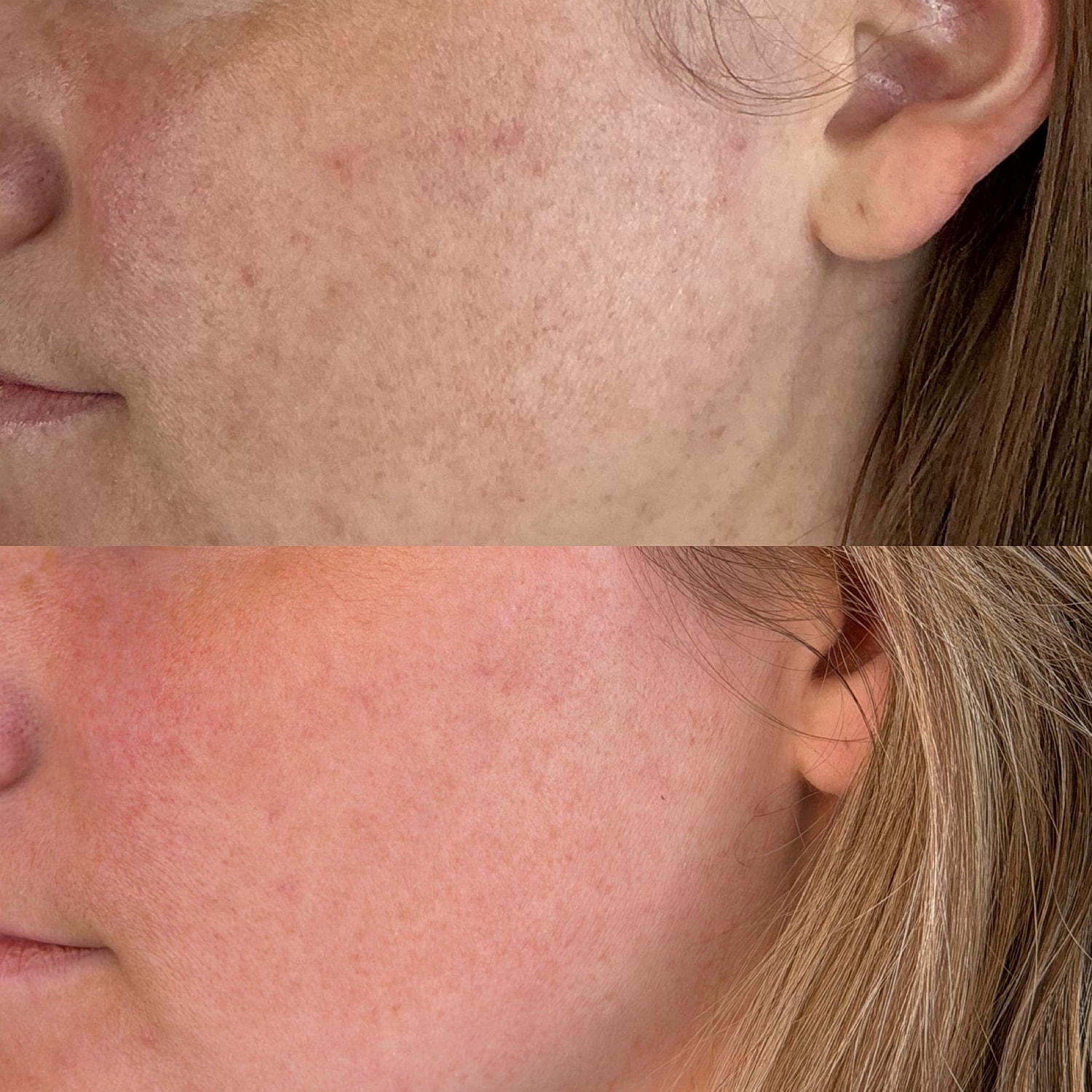 Handheld laser device for skin treatment