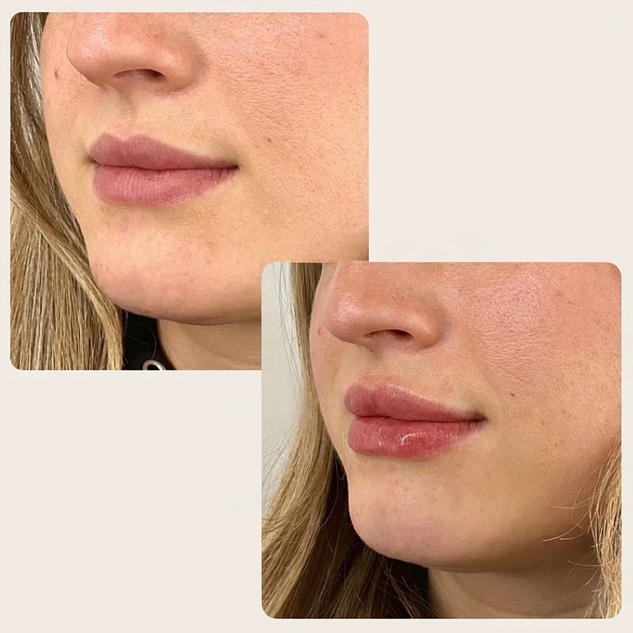 Whitefish dermal filler patient before and after