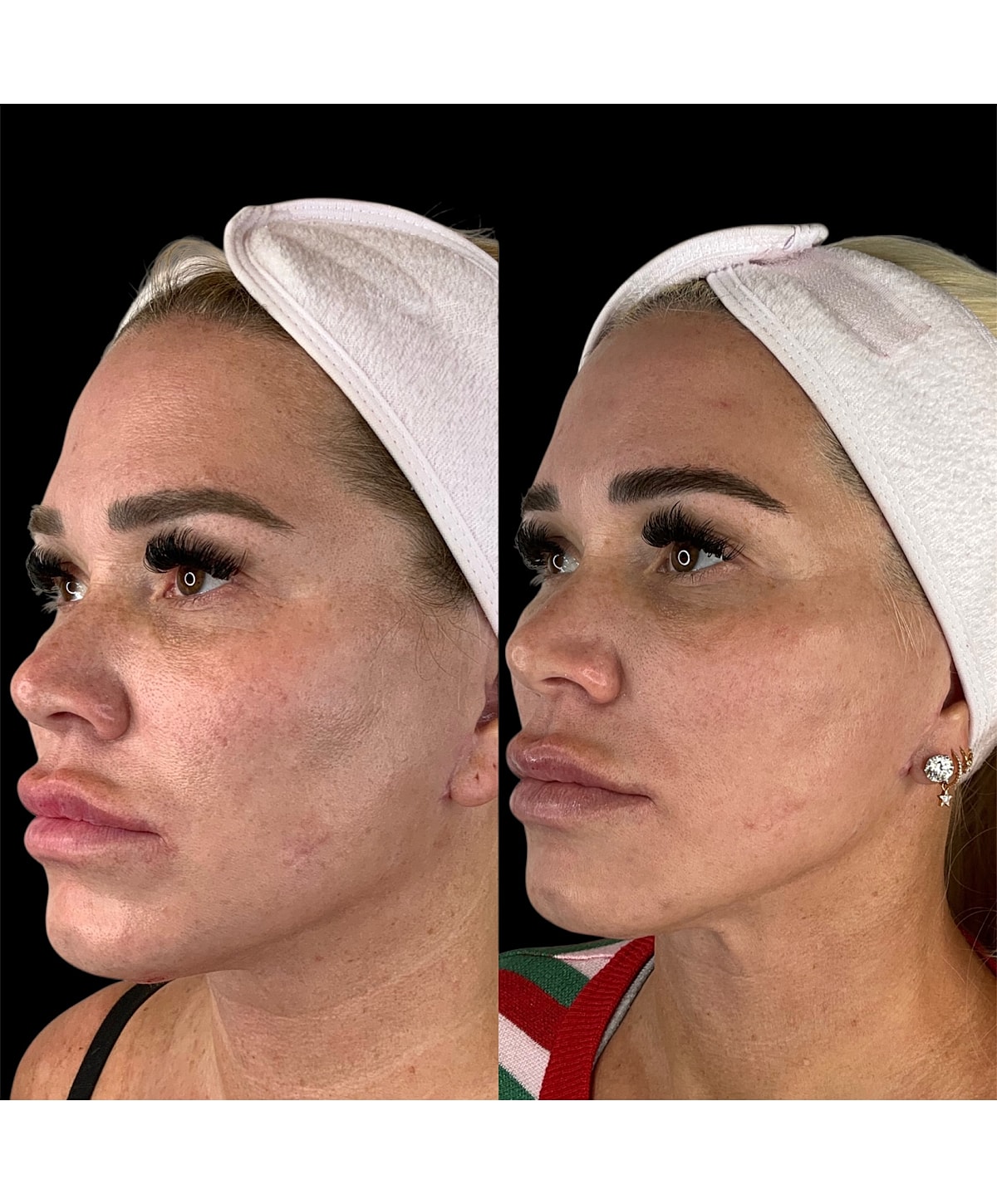 B Whitefish EMFACE model before and after