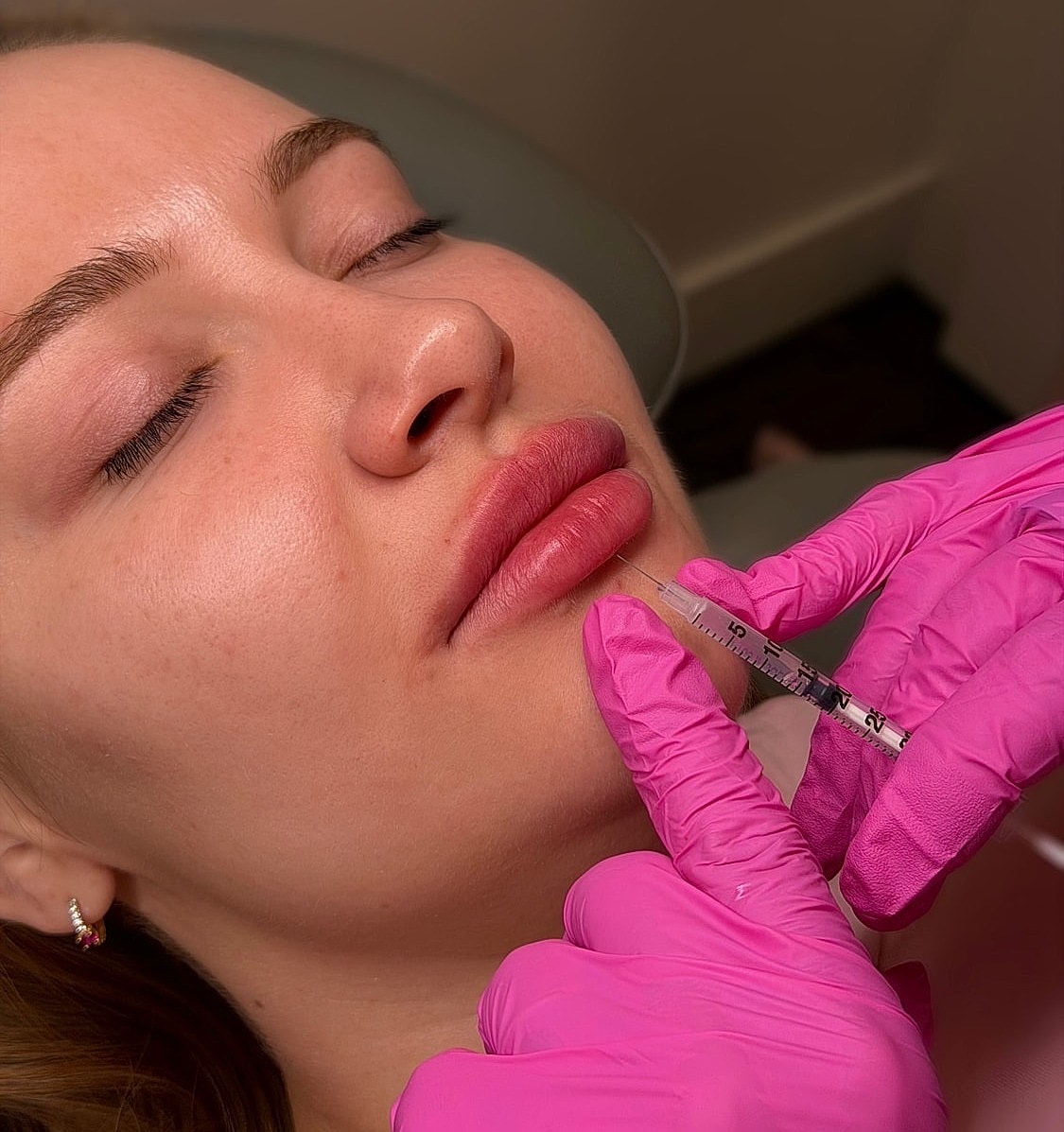 Lip enhancement procedure in progress with syringe.