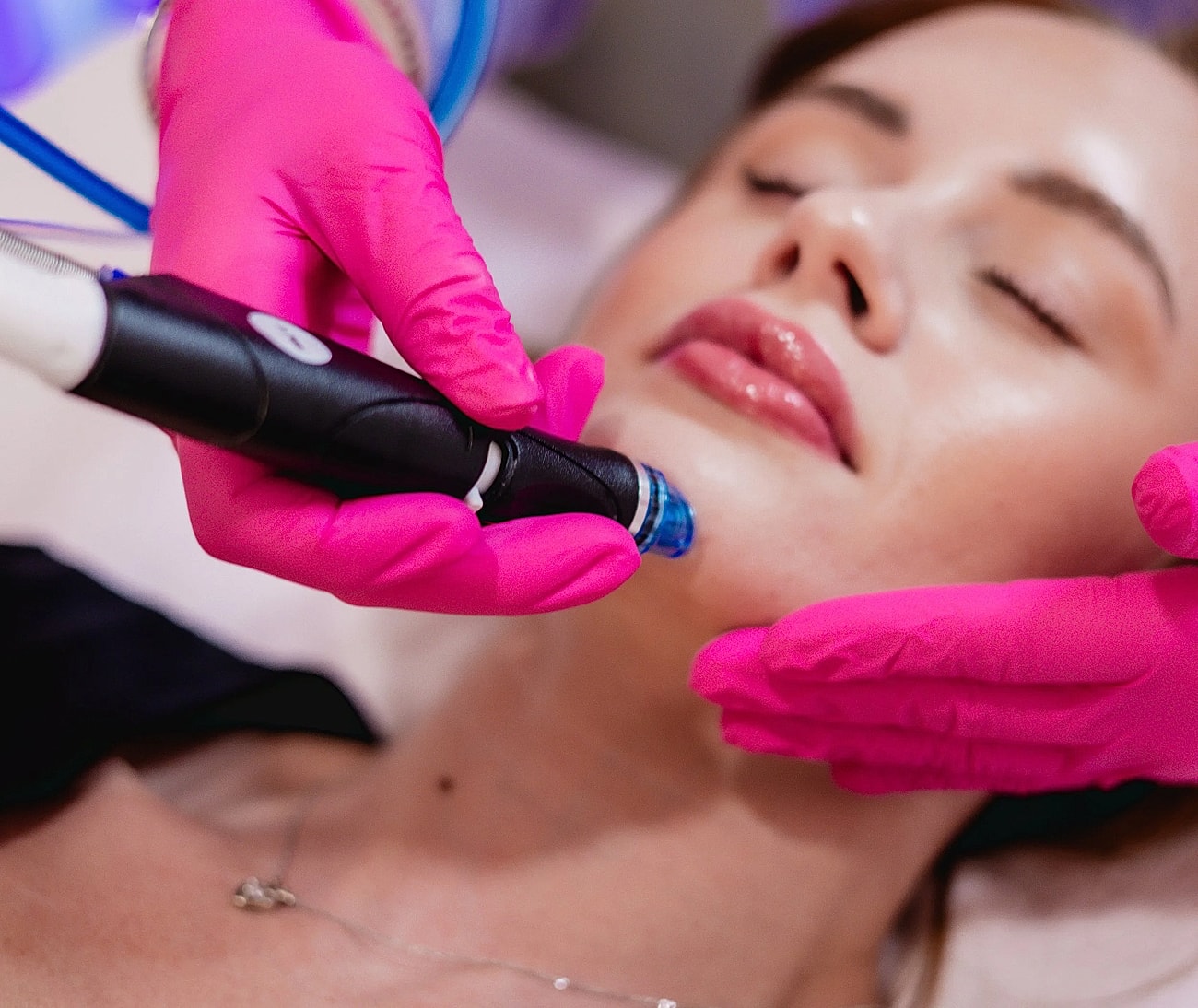 Microneedling treatment in progress on a patient.