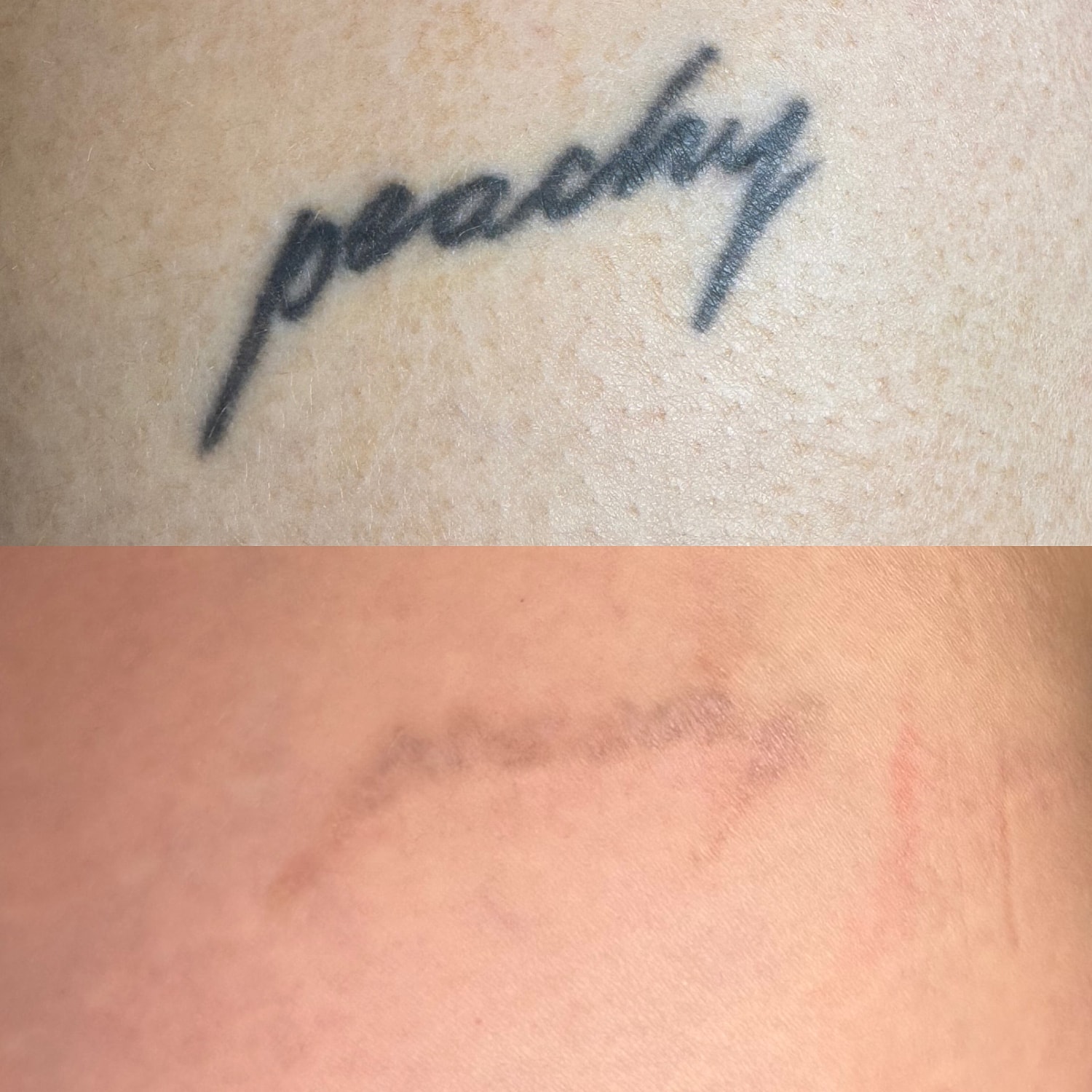 Whitefish Laser Tattoo Removal before and after