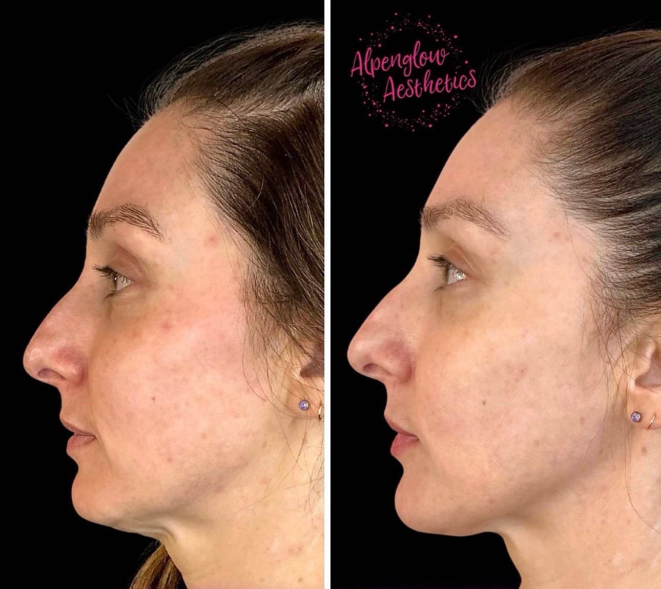 Whitefish dermal filler patient before and after