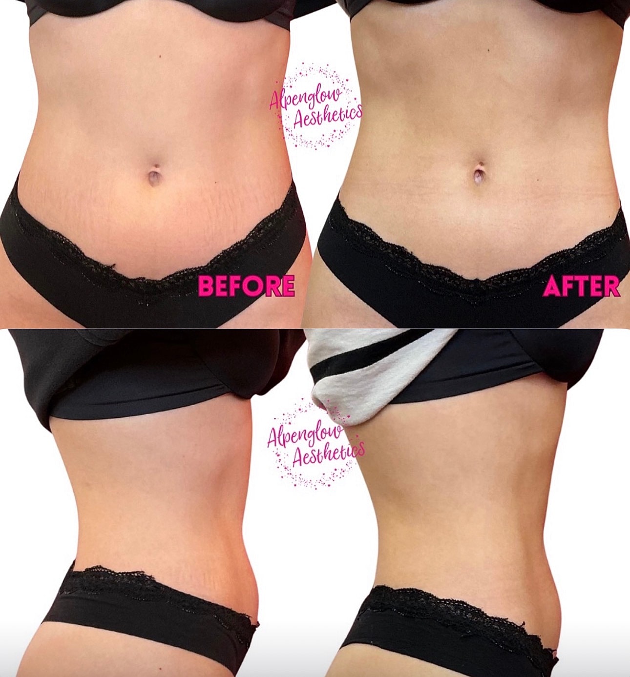 Whitefish Emsculpt Neo model before and after