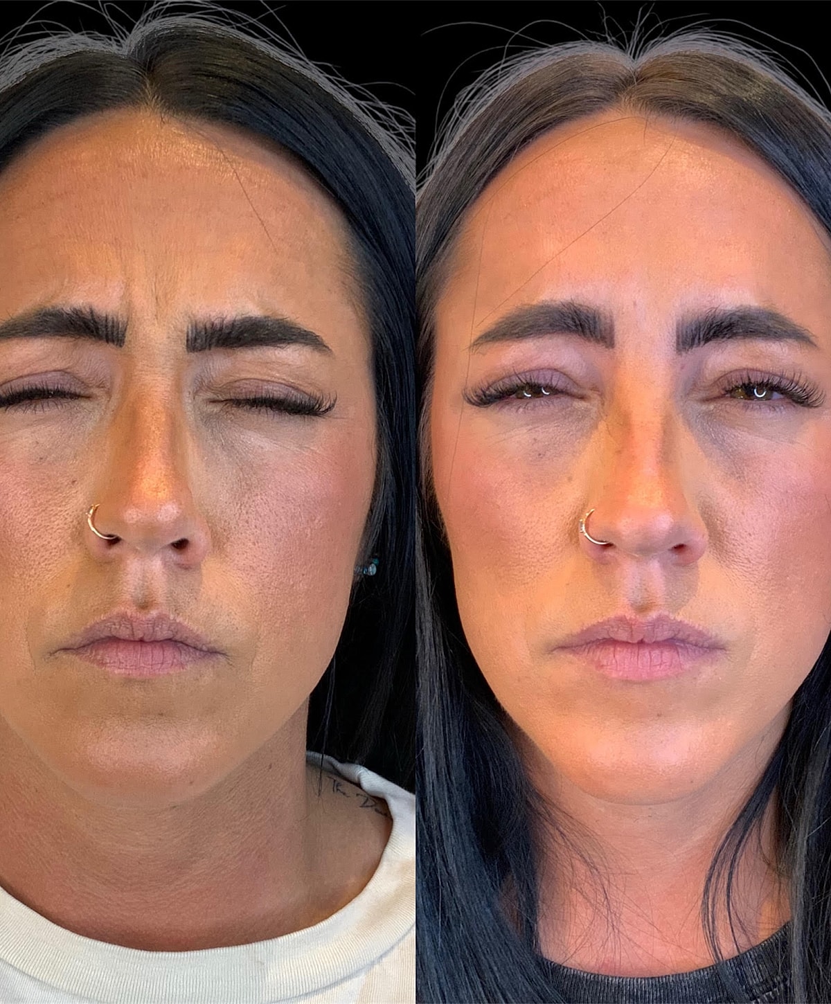 Whitefish Botox patient before and after