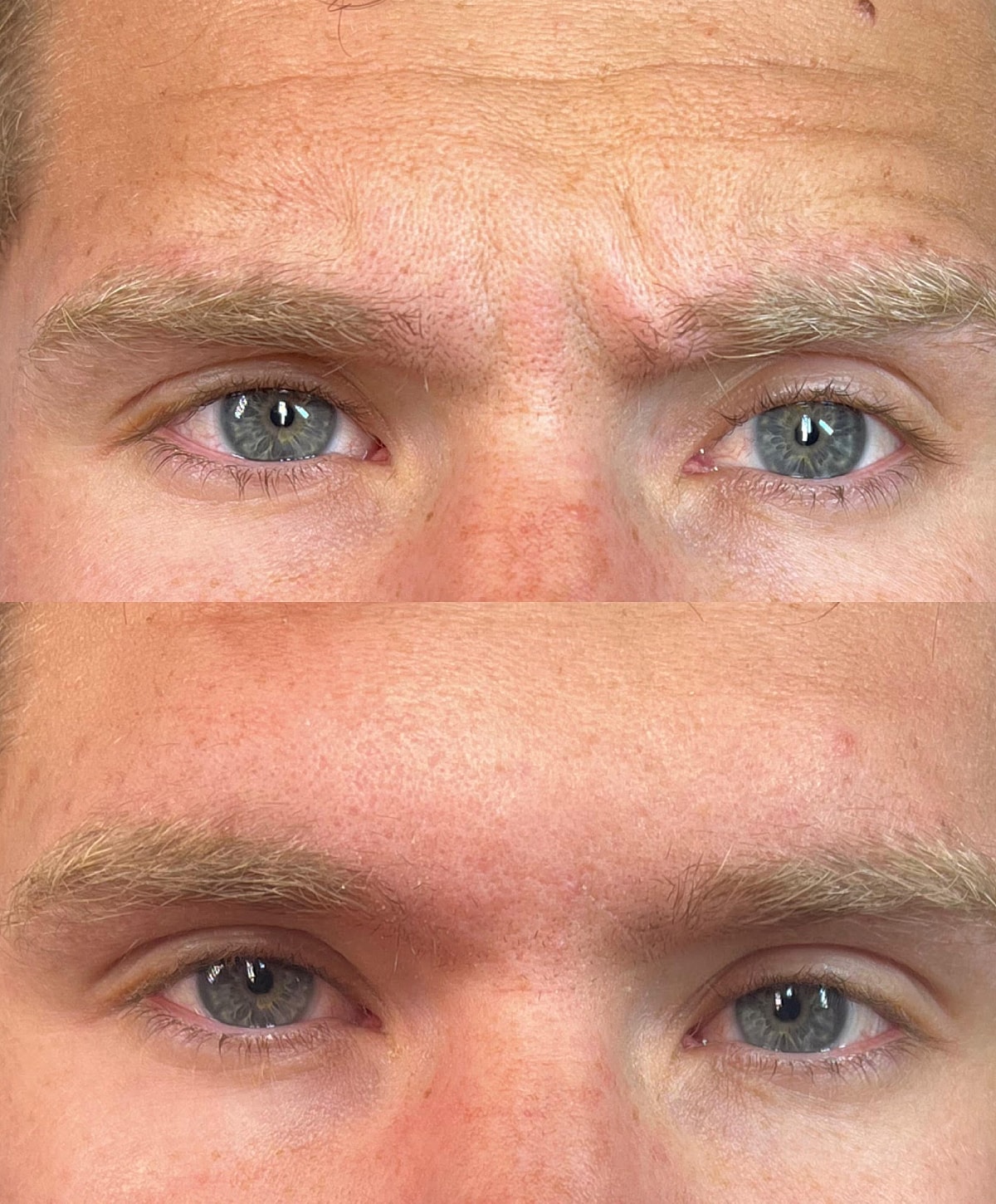 Whitefish Botox patient before and after