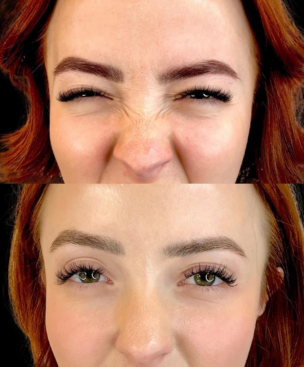 Whitefish Botox patient before and after