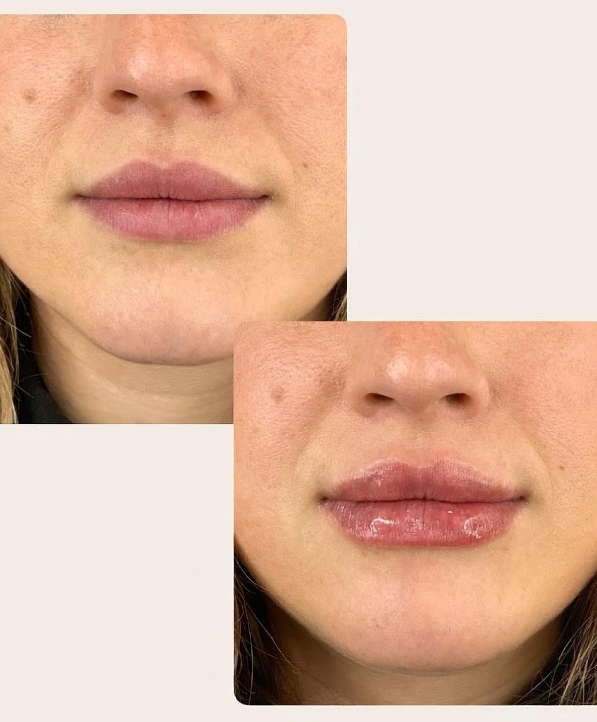 Whitefish dermal filler patient before and after