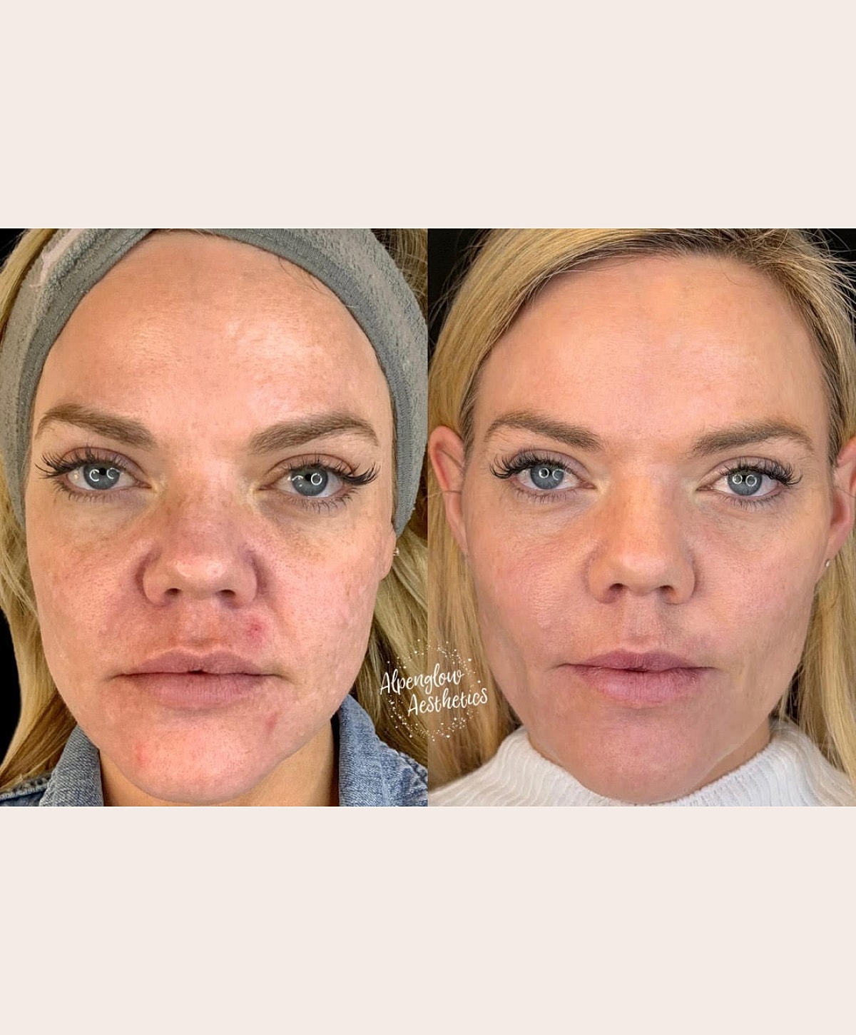 Whitefish dermal filler patient before and after