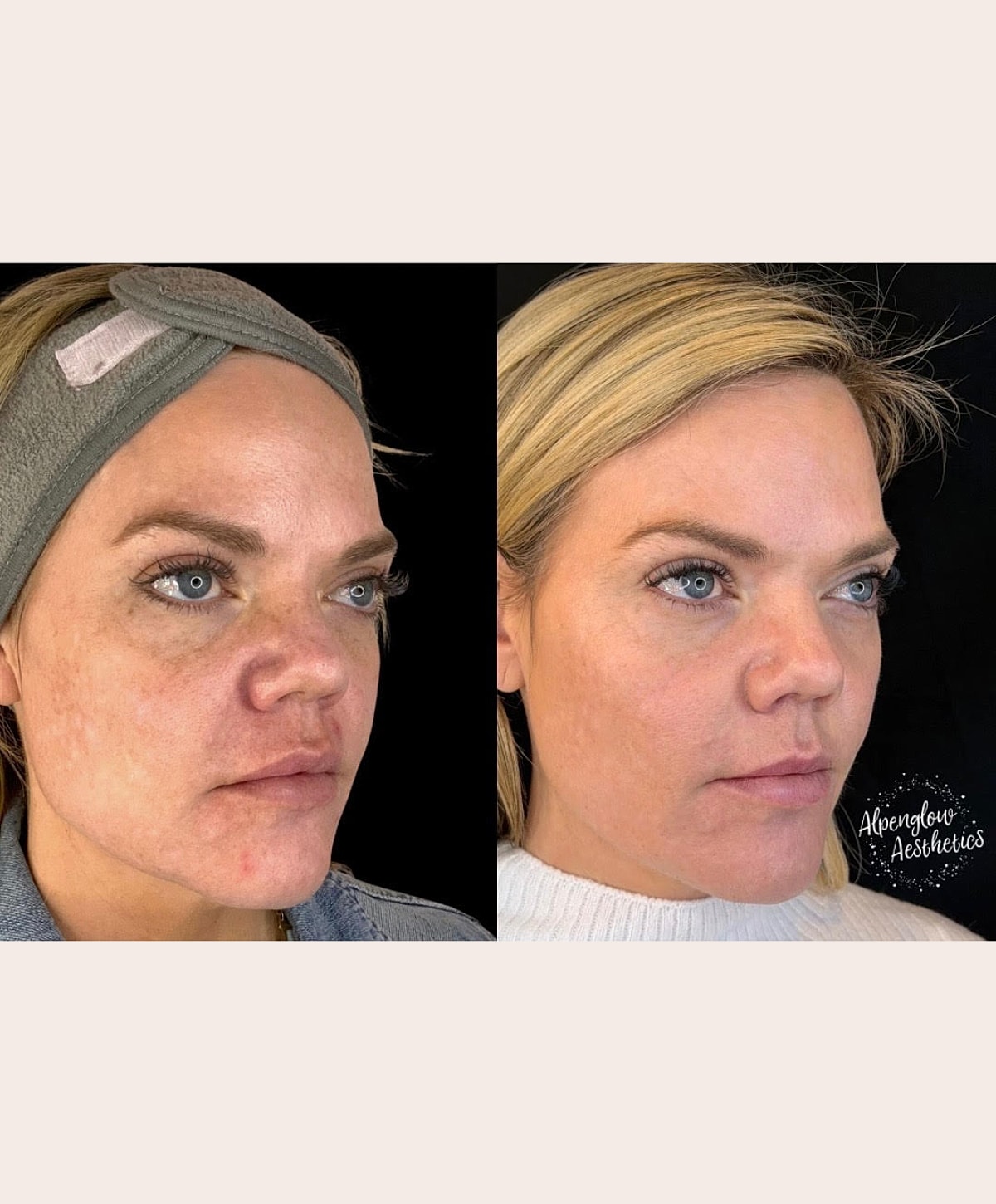 Whitefish dermal filler patient before and after