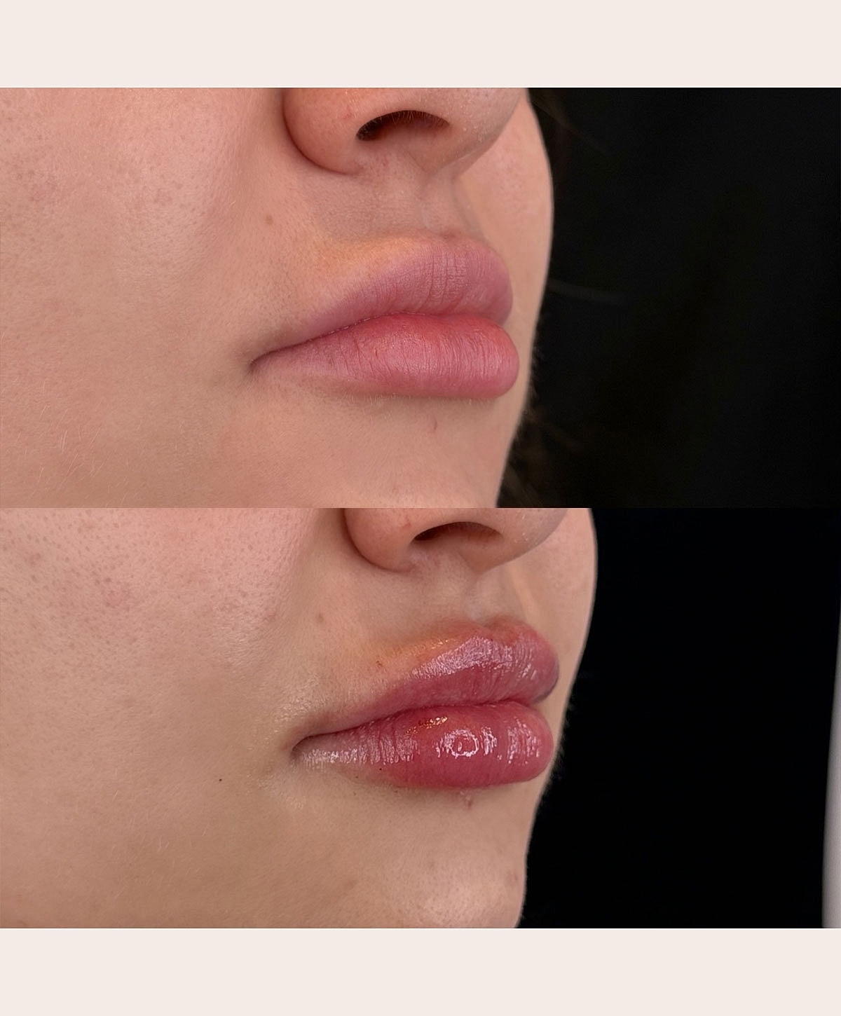 Before and after lip enhancement comparison.