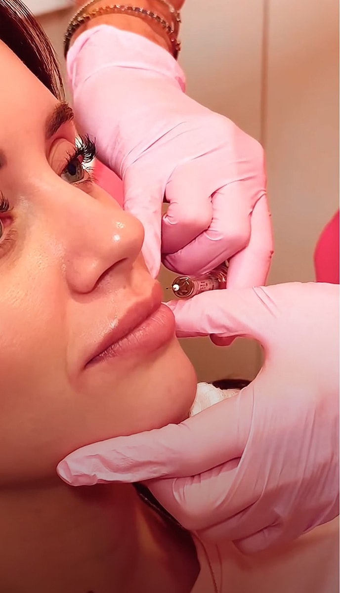 Lip enhancement procedure with needle and gloves.