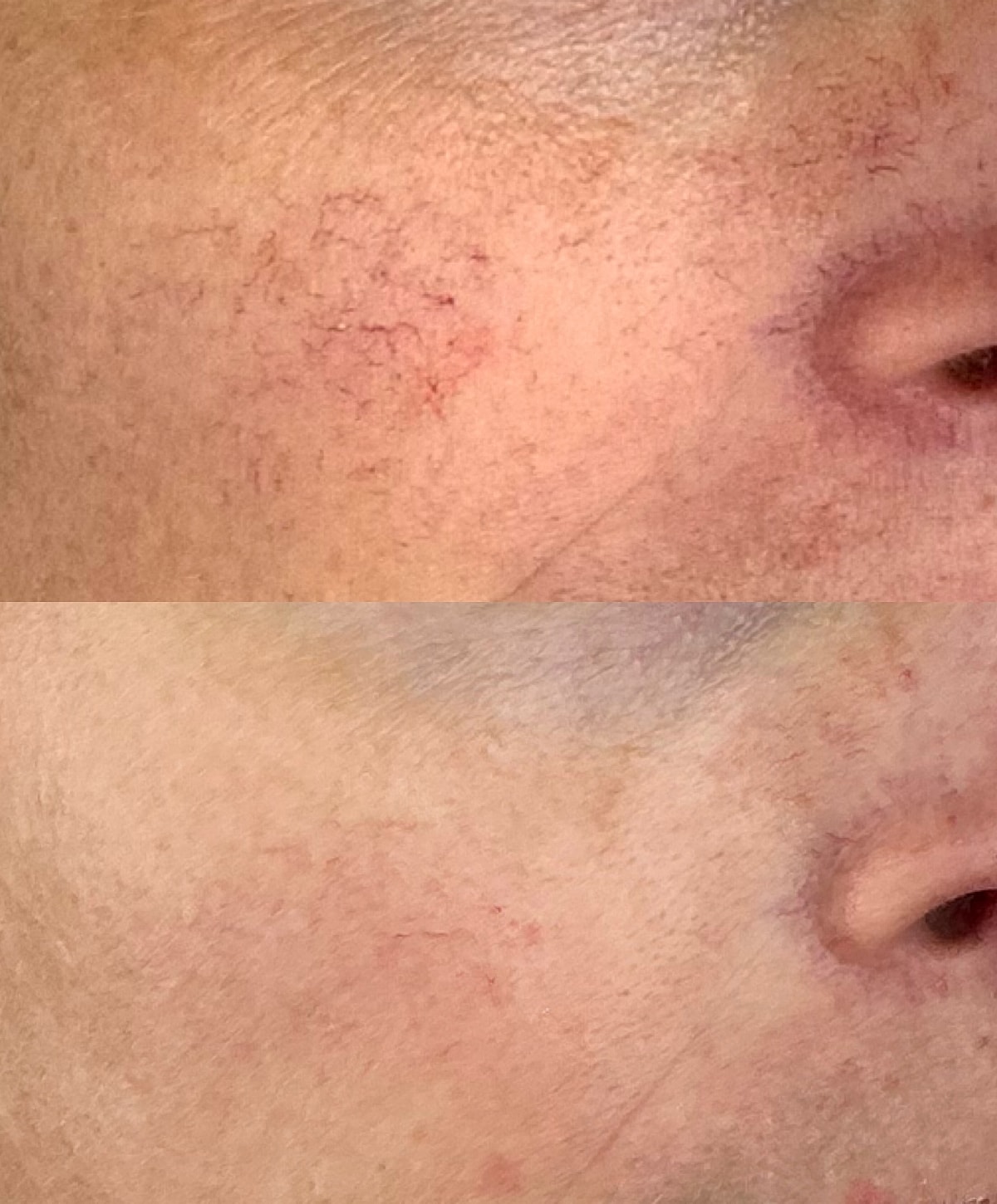 Skin texture before and after treatment comparison.