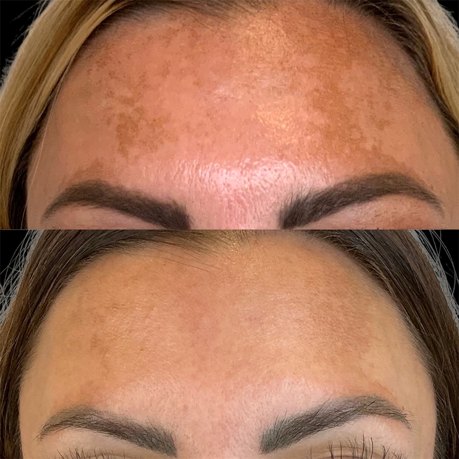 Alma ClearLift Pro device close-up with gloved hand