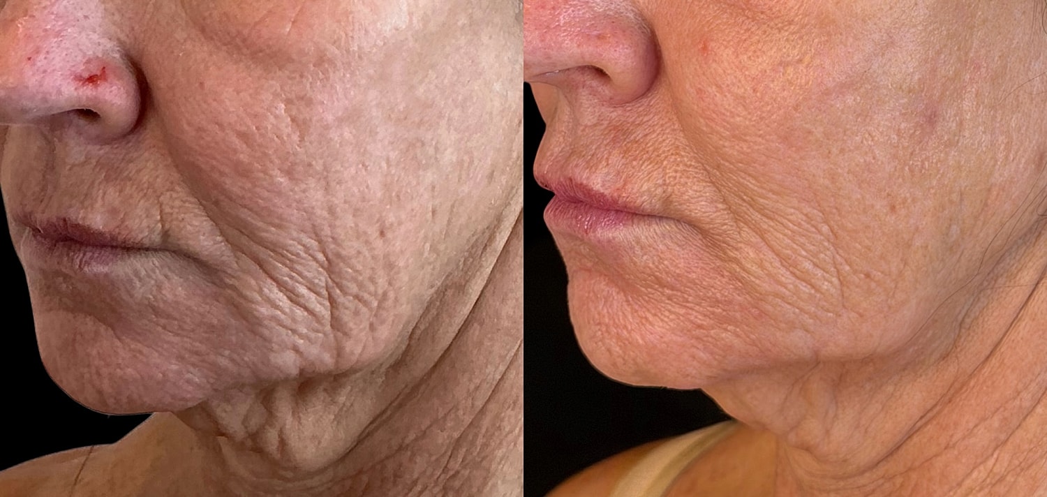 Before and after skin treatment comparison.