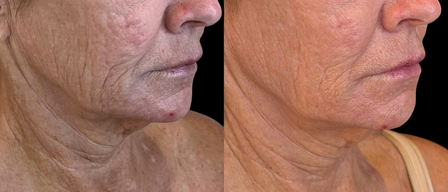 Before and after skin treatment comparison.