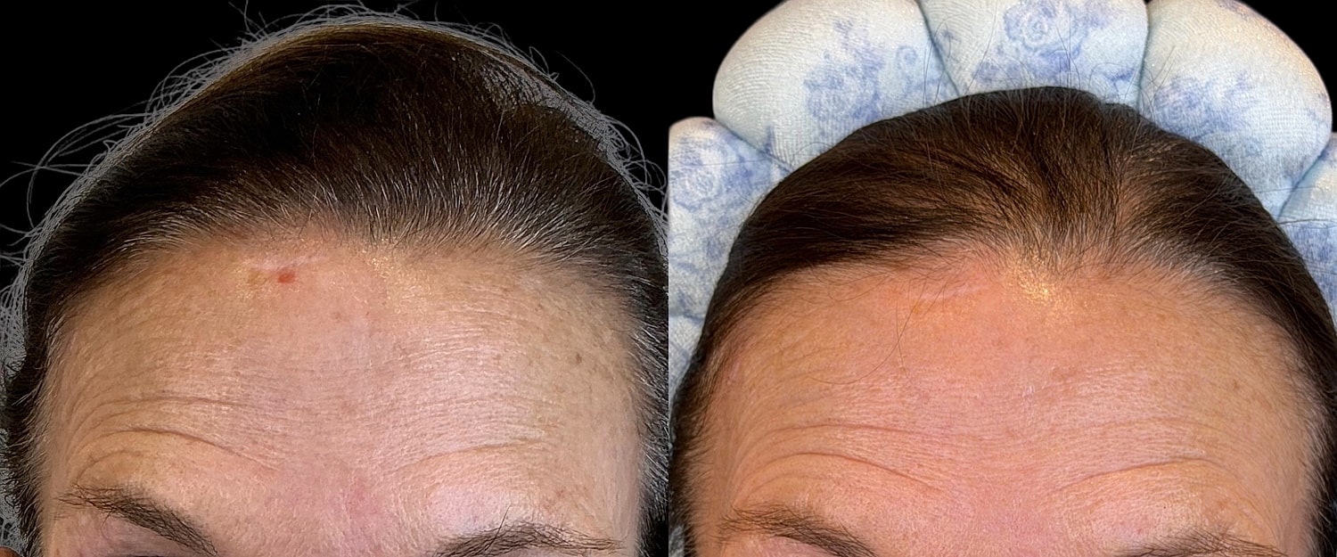 Before and after forehead treatment comparison.