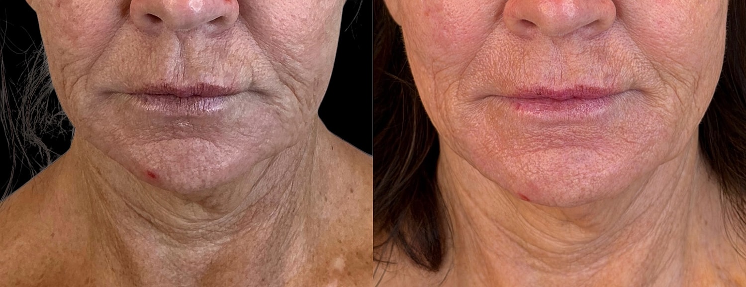 Before and after skin treatment comparison image.
