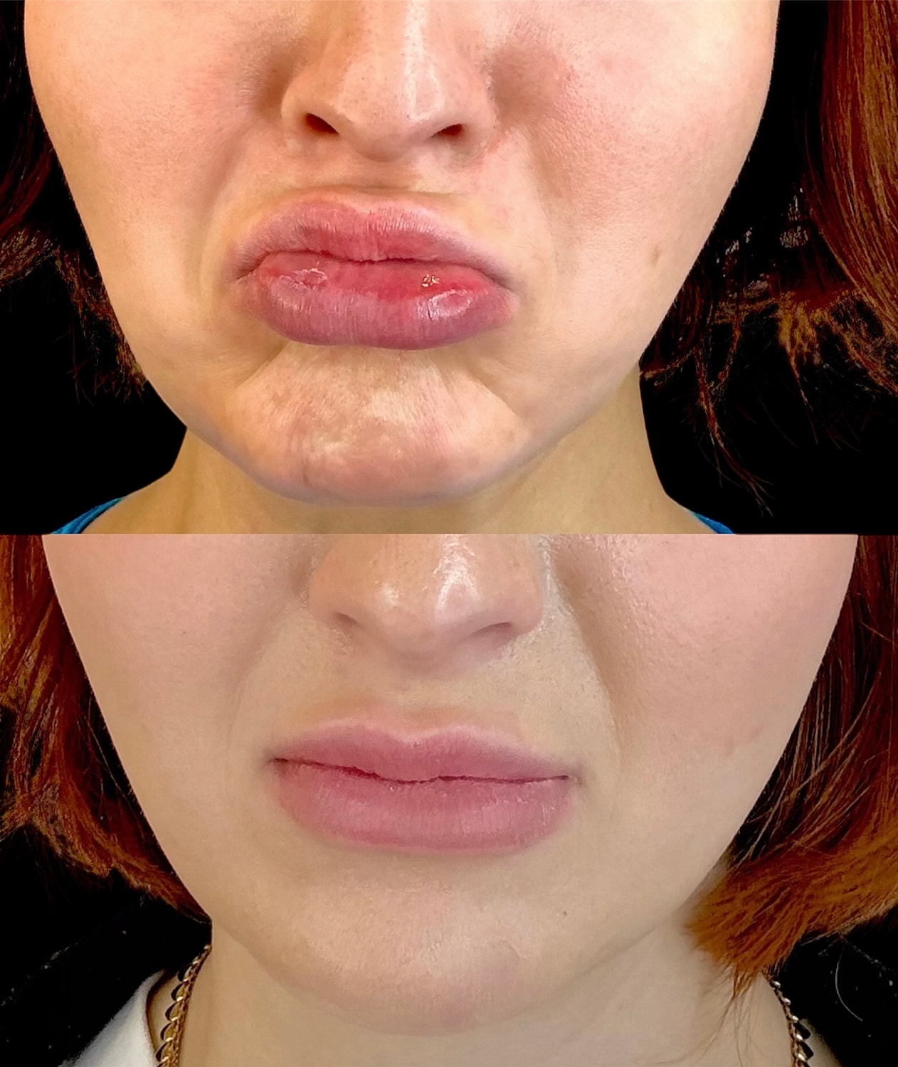 Whitefish Botox patient before and after