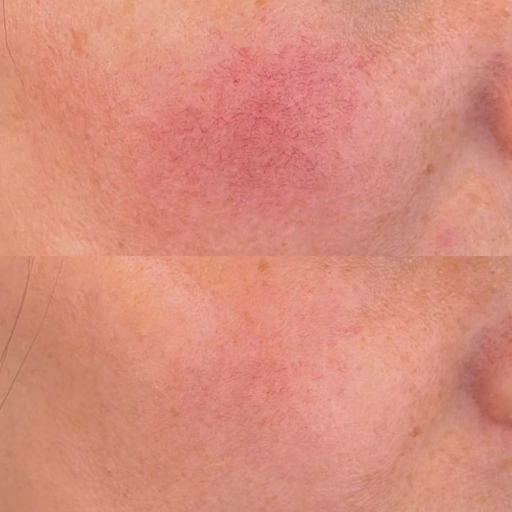 Before and after skin redness treatment comparison.