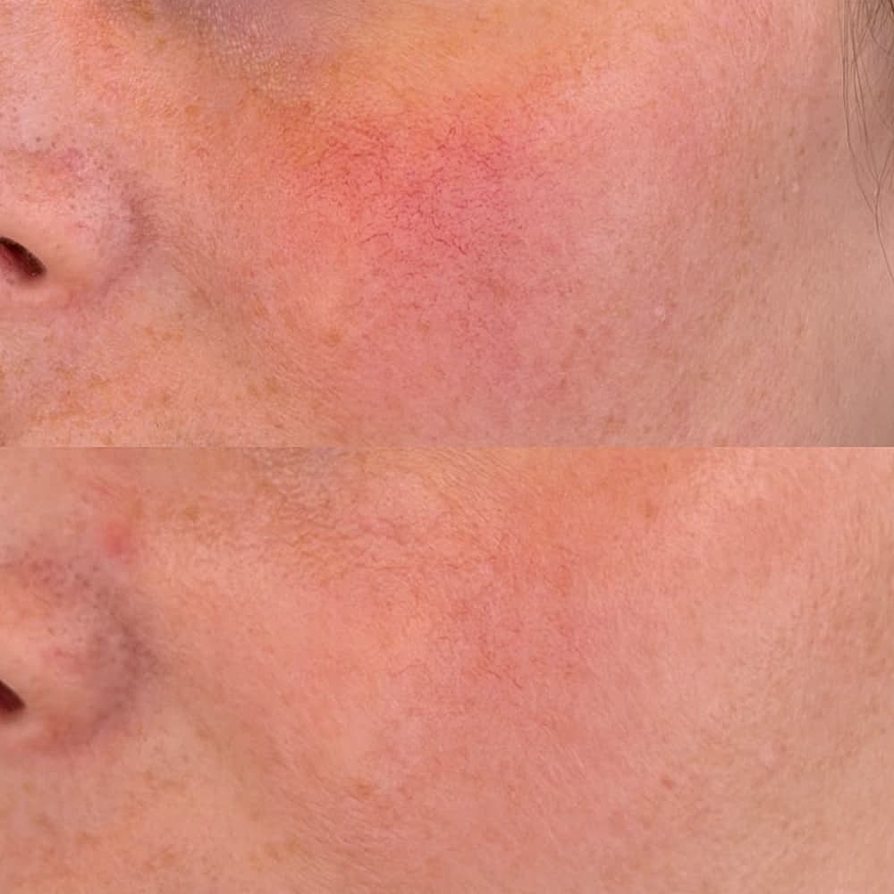 Before and after skin treatment comparison.