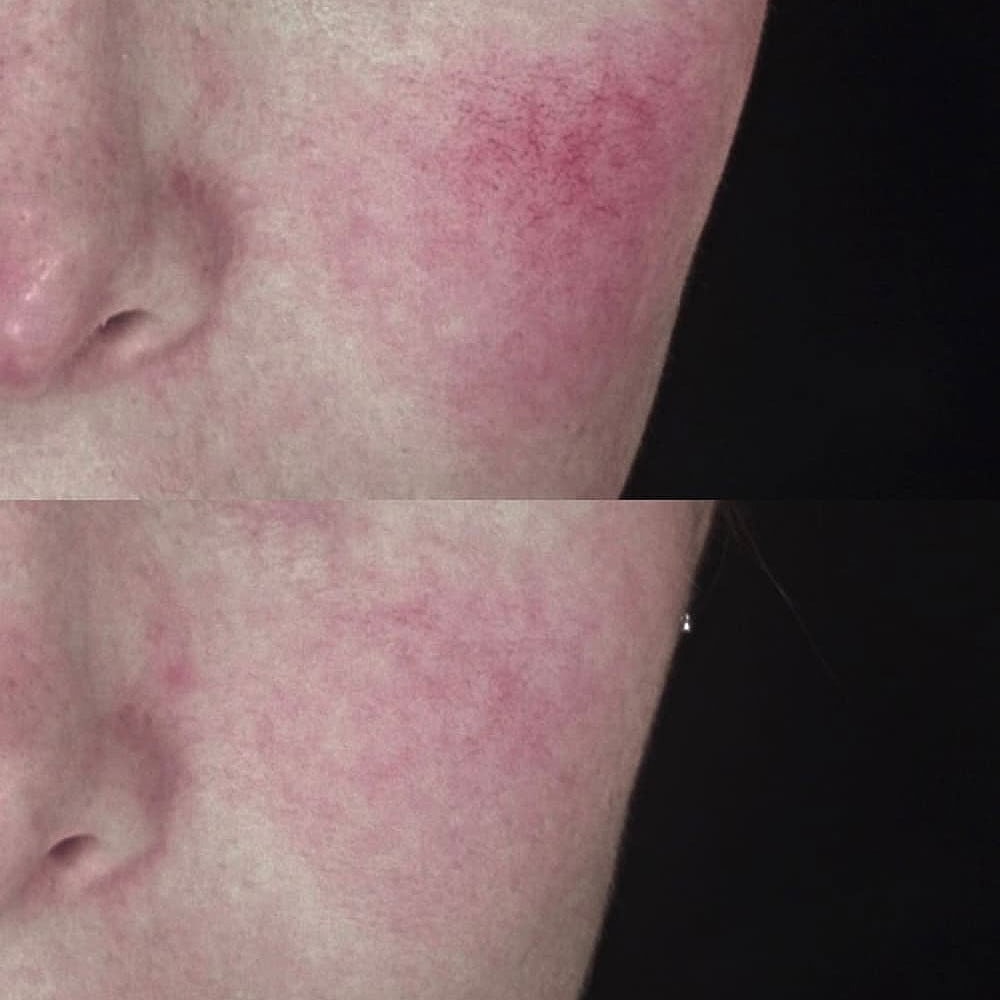 Before and after skin redness treatment comparison.