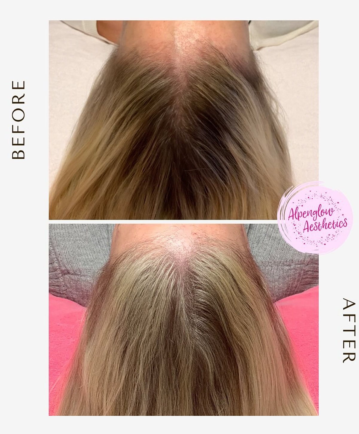 Hair restoration before and after treatment comparison.