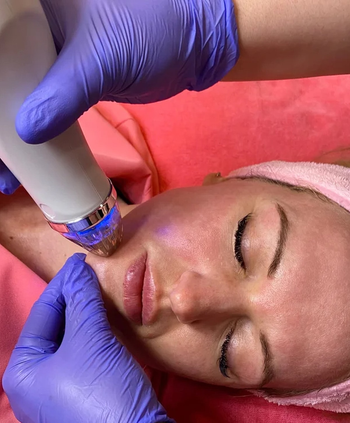 Facial treatment in progress with microneedling device.