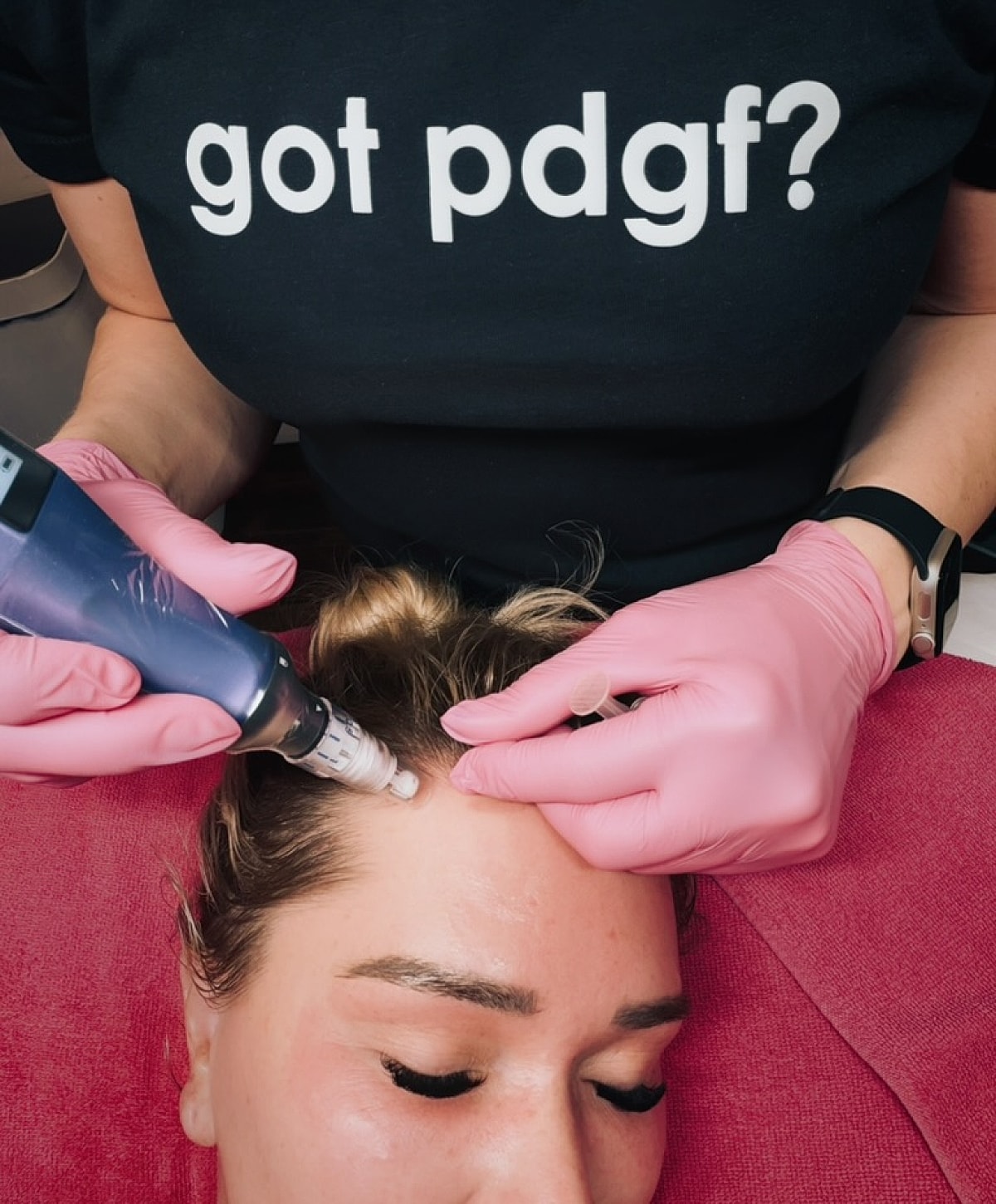 Microneedling treatment with pink gloves applied.