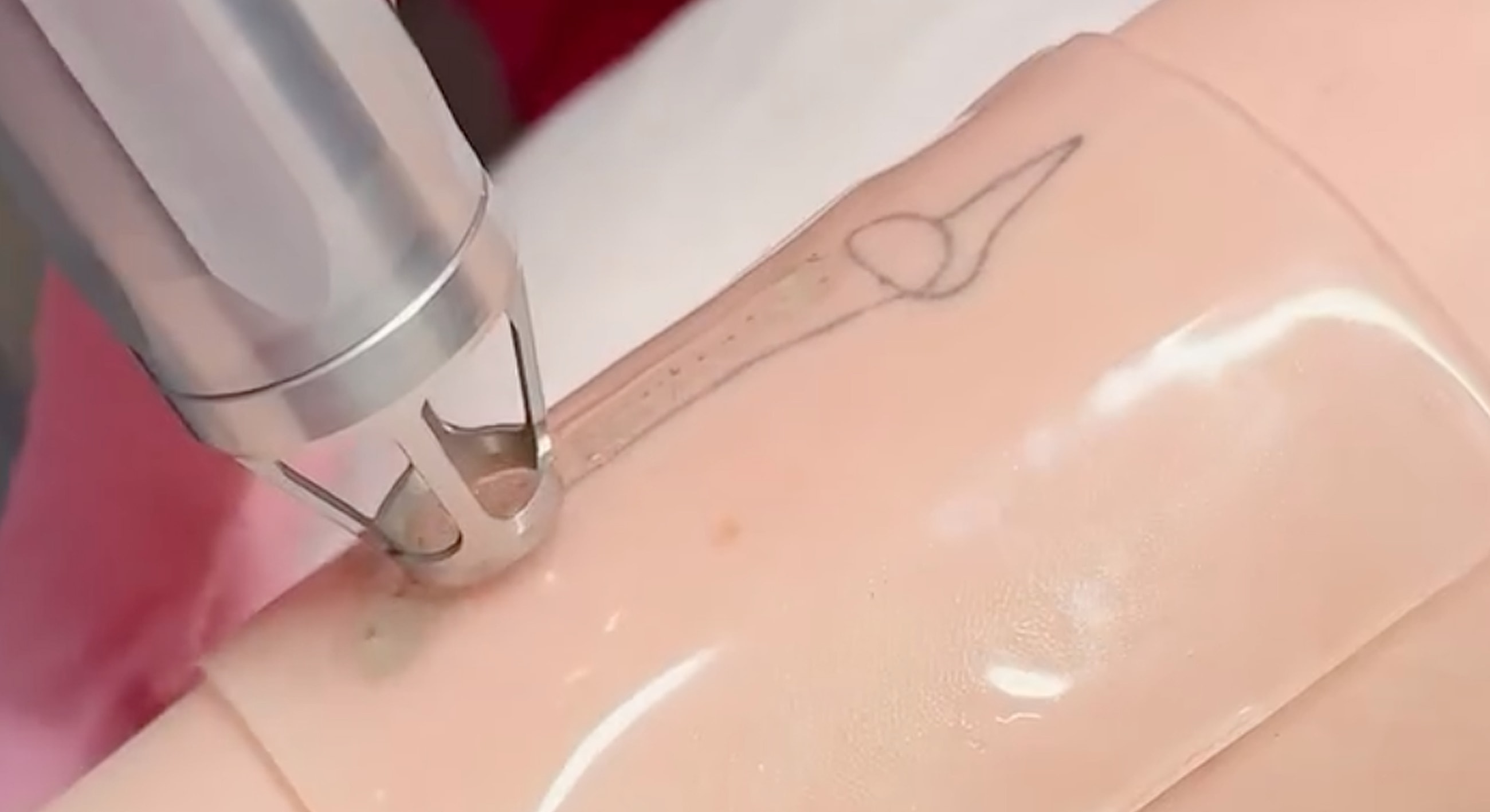 Tattoo removal procedure in progress on skin.